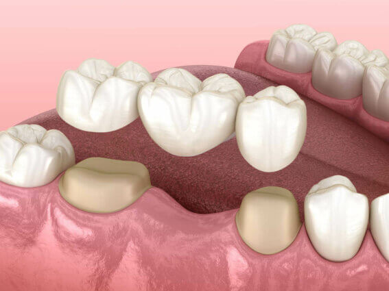 Zahnbrücke mit drei Zähnen über Molar und Prämolar