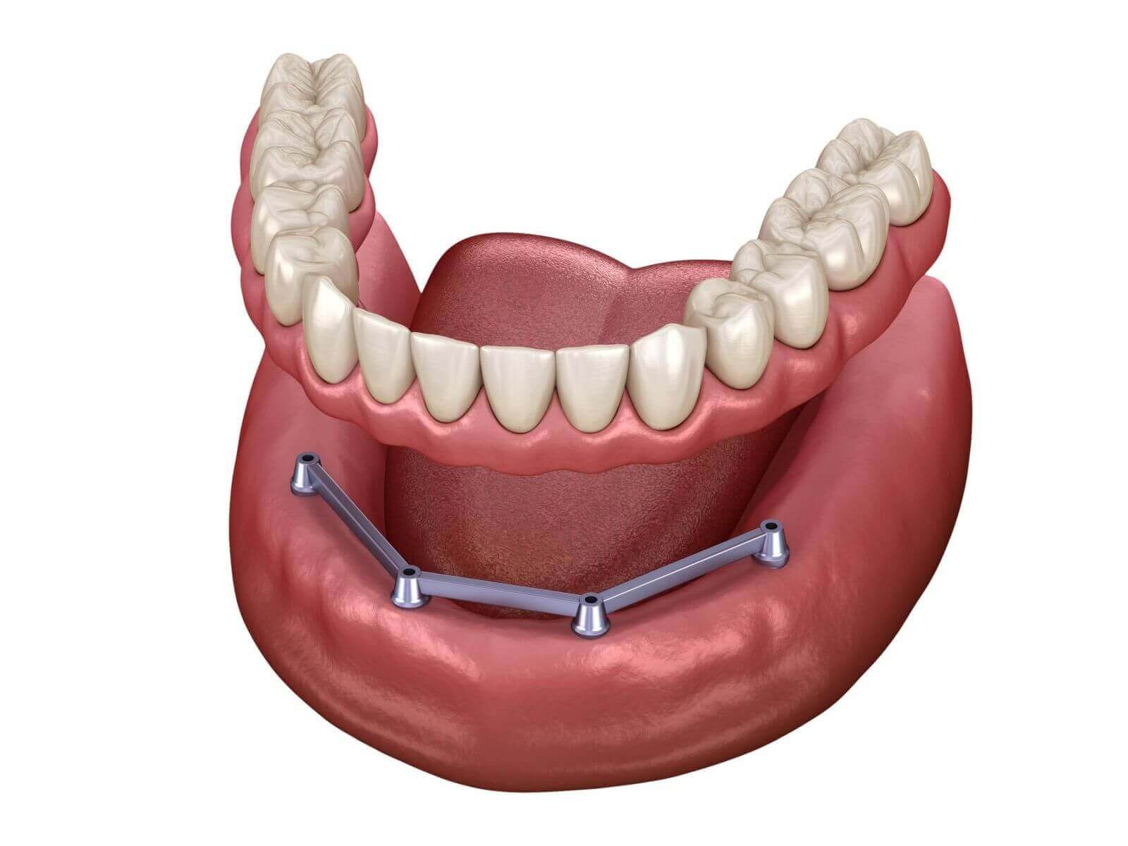 Herausnehmbarer Zahnersatz Zahnprothesen Vielfalt
