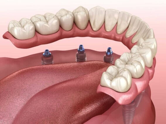 Unterkieferprothese durch Zahnimplantate unterstützt